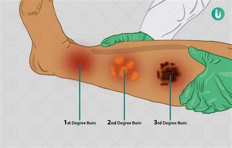 Chemical Burns symptoms, causes, treatment, medicine, prevention, diagnosis