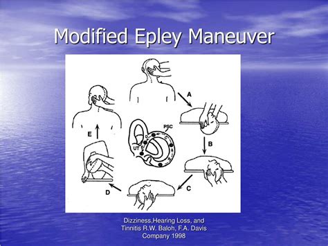 Get Epley Maneuver Steps With Pictures Pics