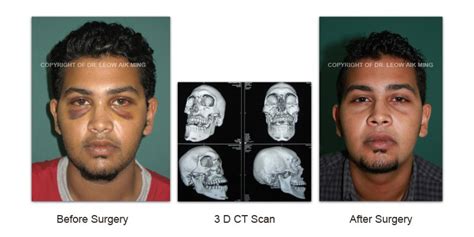 Craniofacial Trauma Reconstruction – MSPRS