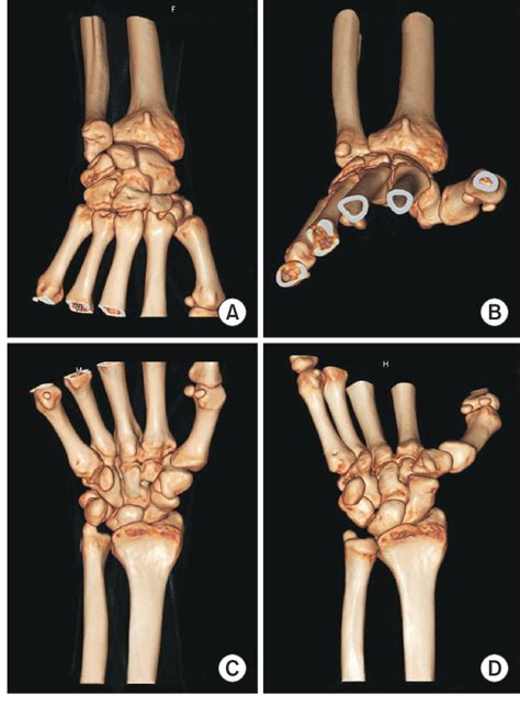 Figure 8 from Where Is the Ulnar Styloid Process? Identification of the Absolute Location of the ...