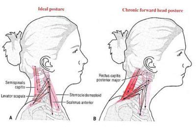 Forward Head Posture - Physiopedia