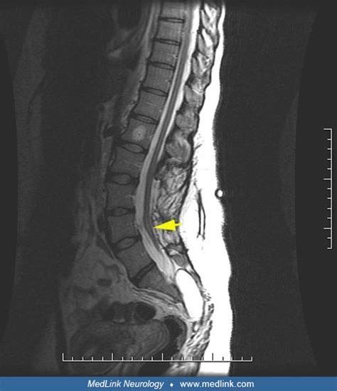 Tethered spinal cord | MedLink Neurology