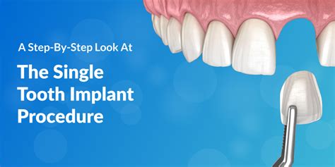 A Step-By-Step Look At The Single Tooth Implant Procedure - LA Dental ...