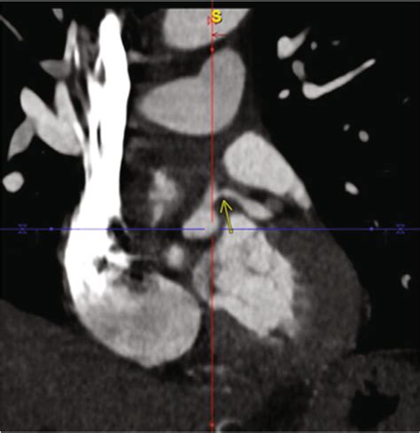 (a and b) Coronary CT angiography demonstrating proximal left... | Download Scientific Diagram