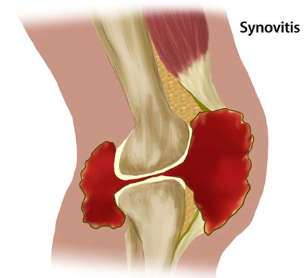 Untreated Bleeding in the Joints > Complications > HoG Handbook > Hemophilia of Georgia