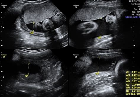 Amniotic Fluid - Excess, Low, and Leaking Amniotic Fluid