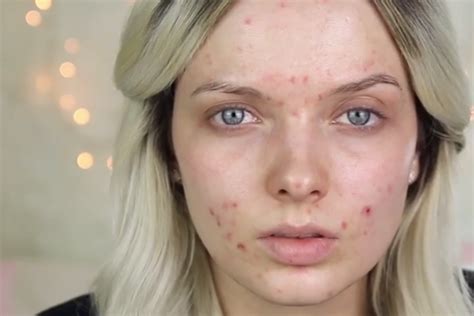 Women are posting makeup-free selfies to spread acne positivity | The Independent | The Independent