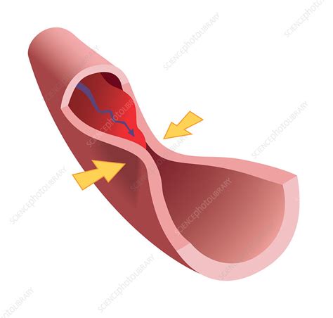 Coronary artery spasm, illustration - Stock Image - C045/8350 - Science ...