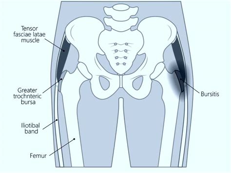 Hip Bursitis Anatomy