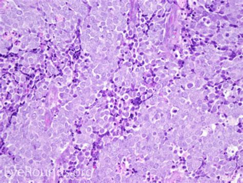 Merkel Cell Carcinoma Histology / Merkel Cell Carcinoma Treatment Pdq Health Professional ...