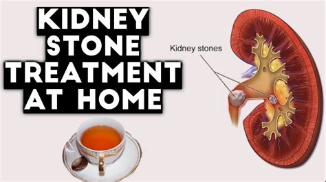 Quick Kidney Stone treatment at home - YouTube
