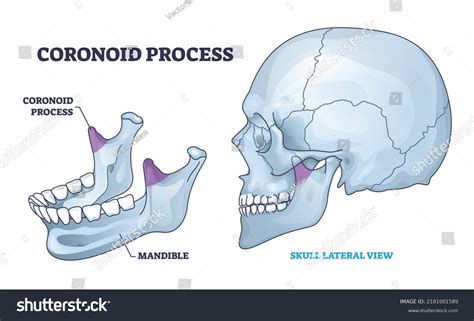 Coronoid Process