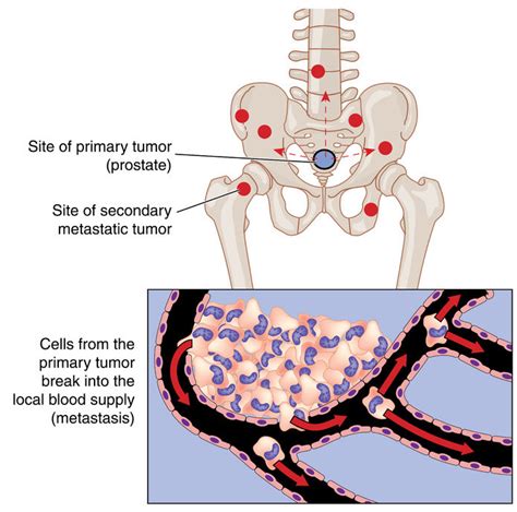 Spinal Tumors: Descriptive Overview