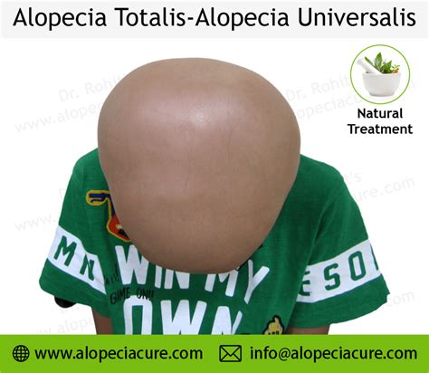 Alopecia Universalis