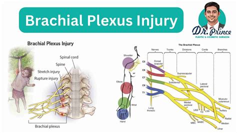 Brachial Plexus Injury - topplasticsurgery