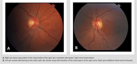 Color Fundus Photos of Patient's Right and Left Eye | Download ...