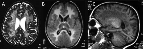 Metachromatic leukodystrophy: MRI in a 4-year-old child with normal... | Download Scientific Diagram