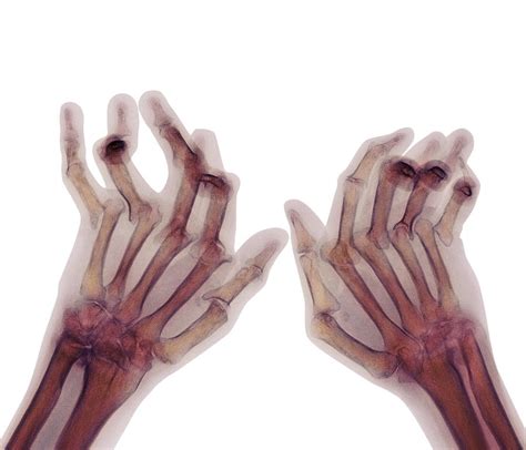 Arthritic Hands, X-ray Photograph by Cnri