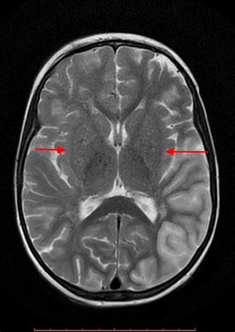 Moyamoya Disease - Causes, Symptoms, Life Expectancy, Treatment