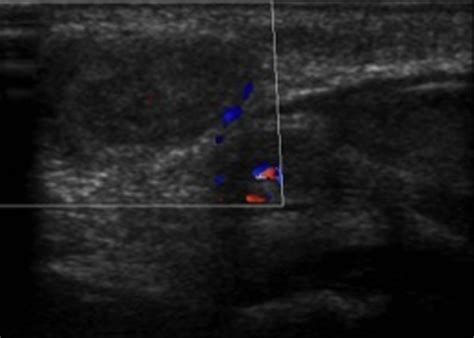 Ultrasound image of the left part of the interior inguinal canal,... | Download Scientific Diagram