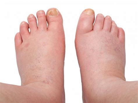 Is There a Connection between Amlodipine and Edema?