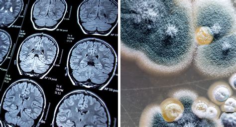 Mold In Man's Brain Caused Abscesses Like 'Two Little Dark Circles of ...