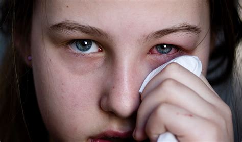 Conjunctivitis: Is Pinkeye Dangerous?