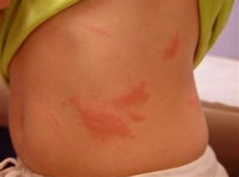 Rash on Stomach - Pictures, Treatment, Symptoms, Causes - HubPages