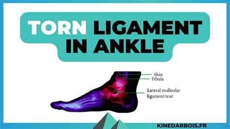 Torn Ligament in Ankle: Recovery Time & Physical Therapy Tips!