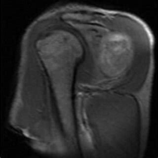 MRI of the right shoulder shows that tumor mass was 13.2 × 4.1 × 7.8cm ...