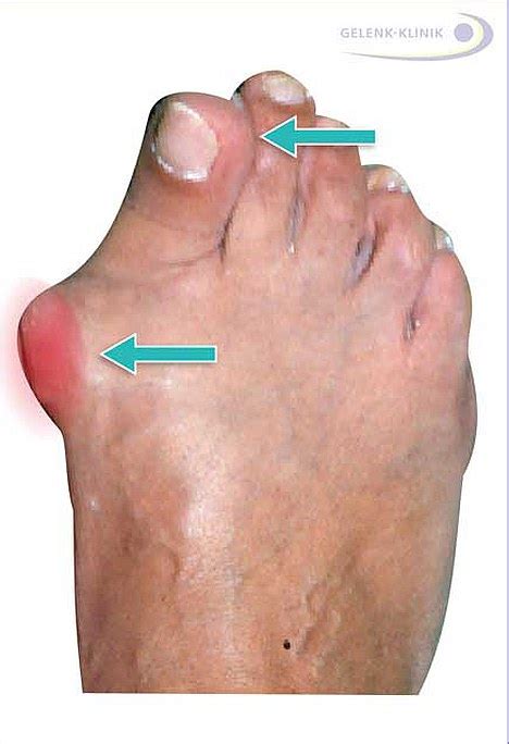 Hallux valgus: Conservative treatment or surgery? | Joint-surgeon.com