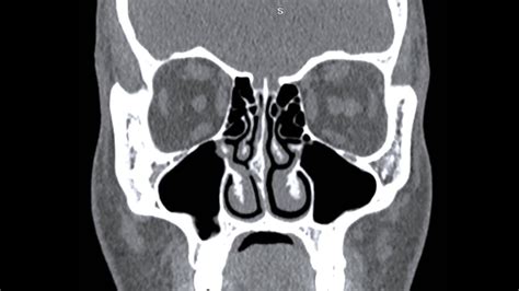 CT Scan Of Paranasal Sinus Axial Coronal, 44% OFF