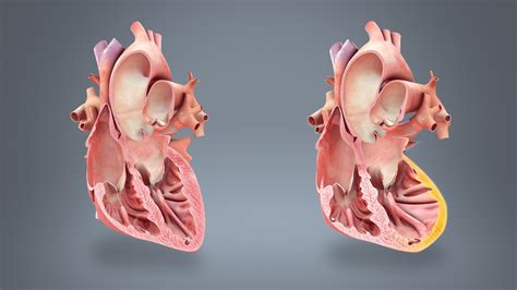 Heart failure shown and explained using medical animtion still shot