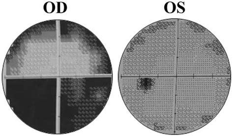 Visual field test of both eyes (Oculus Dexter (OD): the right eye ...