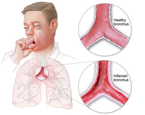 What Is Bronchitis? - StoryMD