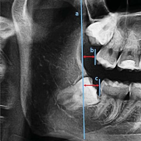 Retromolar space measurements on panoramic radiography (red... | Download Scientific Diagram