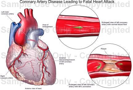 Heart Disease Drawing at GetDrawings | Free download