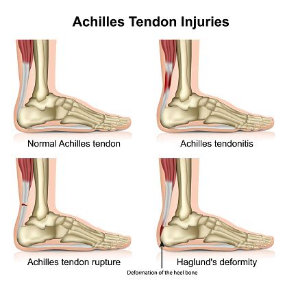 Achilles Tendon Injures Medical Vector Illustration Isolated On White Background With English ...