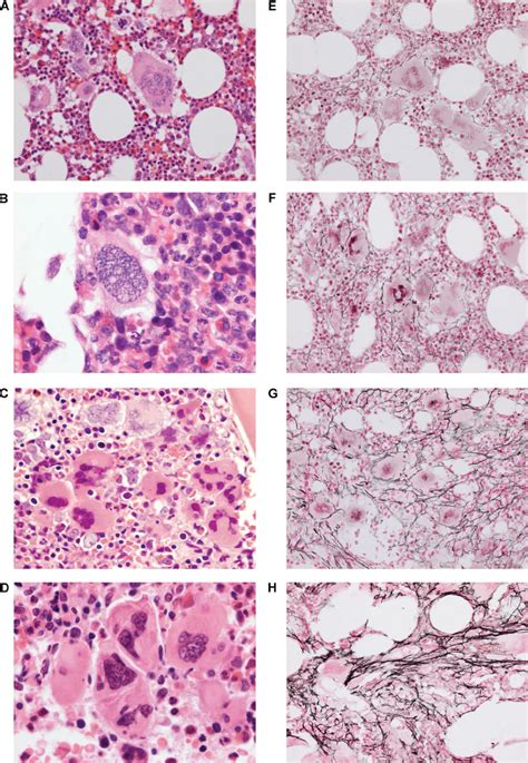 Examples of morphologic features scored on 370 diagnostic bone marrow... | Download Scientific ...