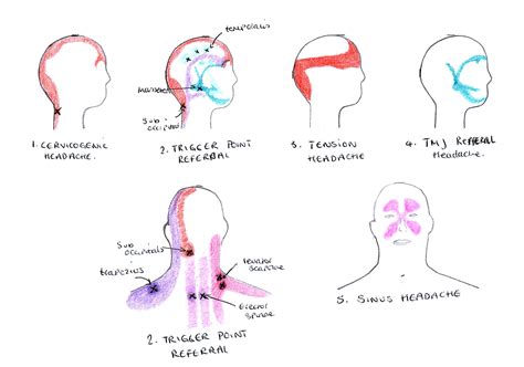 Tension Headache Trigger Points