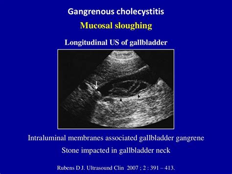 Ultrasound of acute & chronic cholecystitis