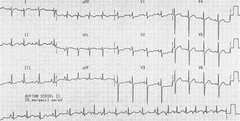 Premature Atrial Contraction Strip