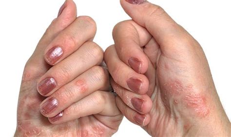 Type 2 diabetes: Skin itching could be an early sign | Express.co.uk