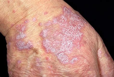 Lichen Planus Picture Image on RxList.com