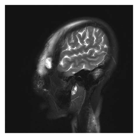 Photograph from the surgery showing the thickened epicranial... | Download Scientific Diagram