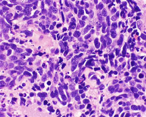 Small Cell Cancer Lung | MedicineBTG.com
