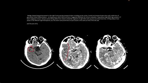 cerebral angiogram - session 2 - YouTube