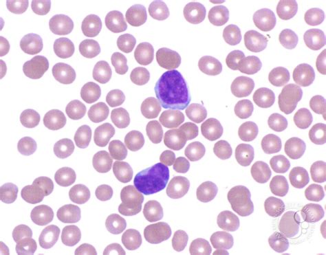 Peripheralizing Follicular Lymphoma with Atypical Morphology - 4.