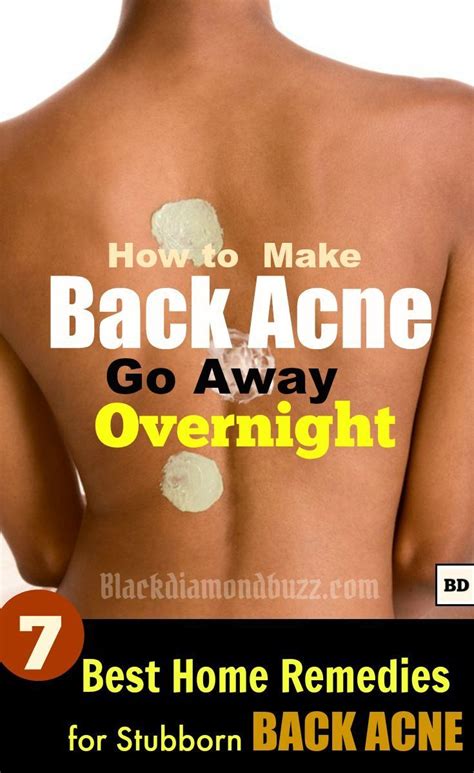 How to Get Rid of Back Acne Overnight – 7 Best Home Remedies for Backne ...