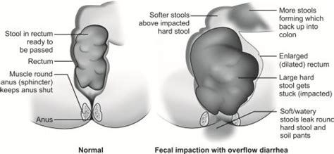 Top Impacted Stool Treatment of the decade Learn more here | stoolz